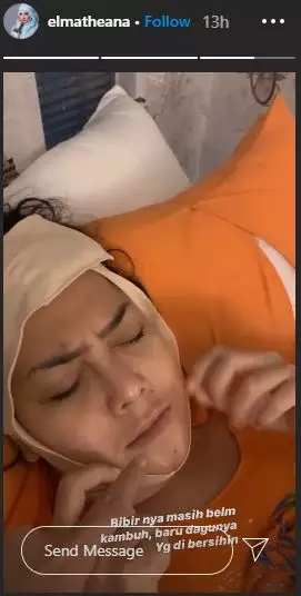 rency bengkak Instagram