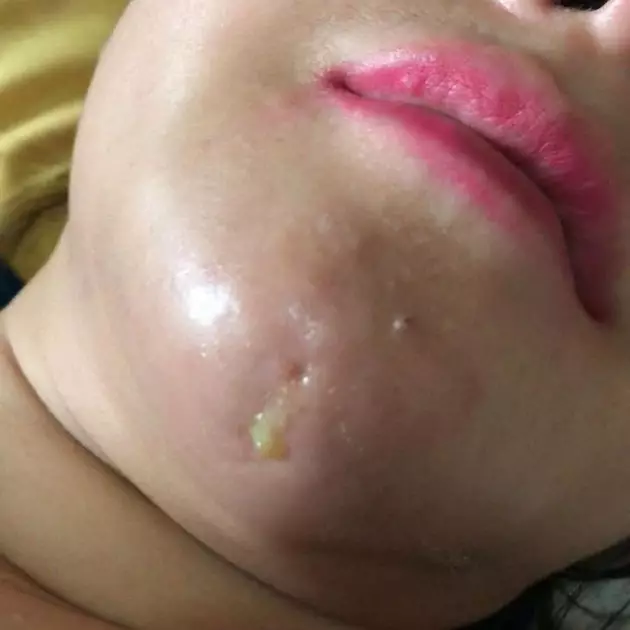 rency bengkak Instagram