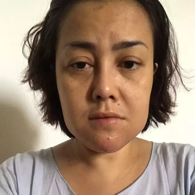 rency bengkak Instagram