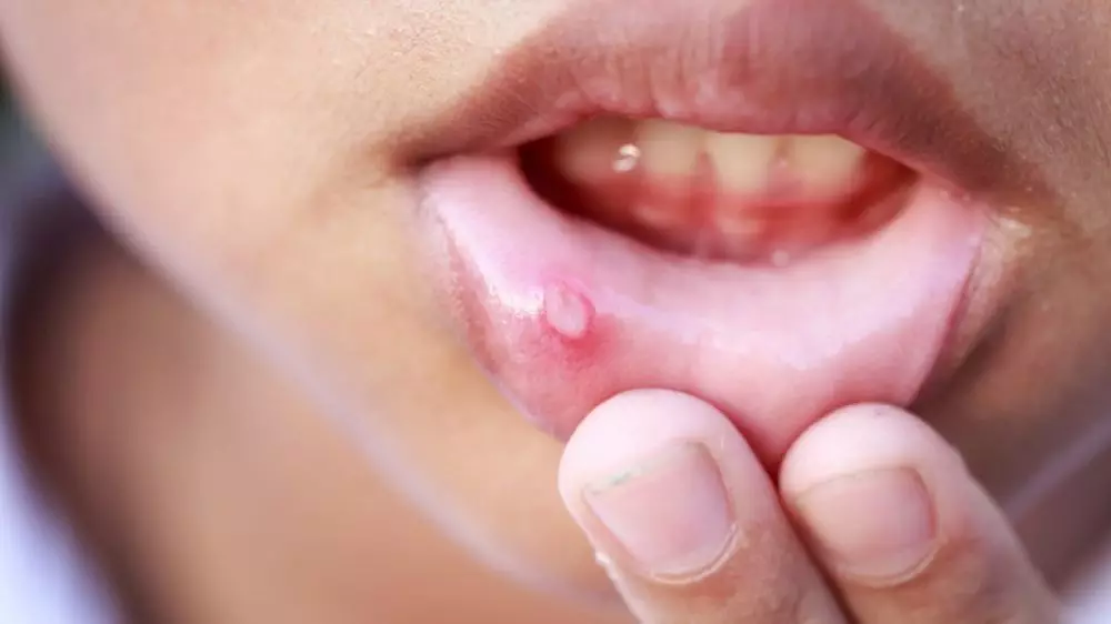 Manfaat berkumur dengan air garam © 2020 brilio.net