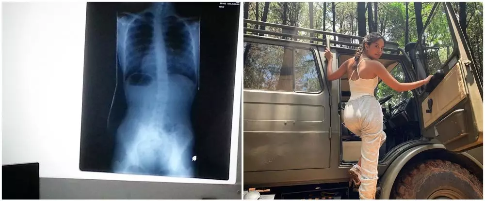 seleb idap skoliosis © 2020 Instagram