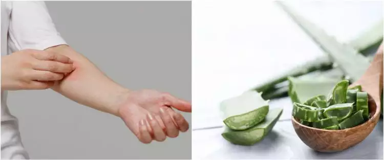 7 Bahan alami untuk menghilangkan gatal kulit, ampuh dan mudah dipakai