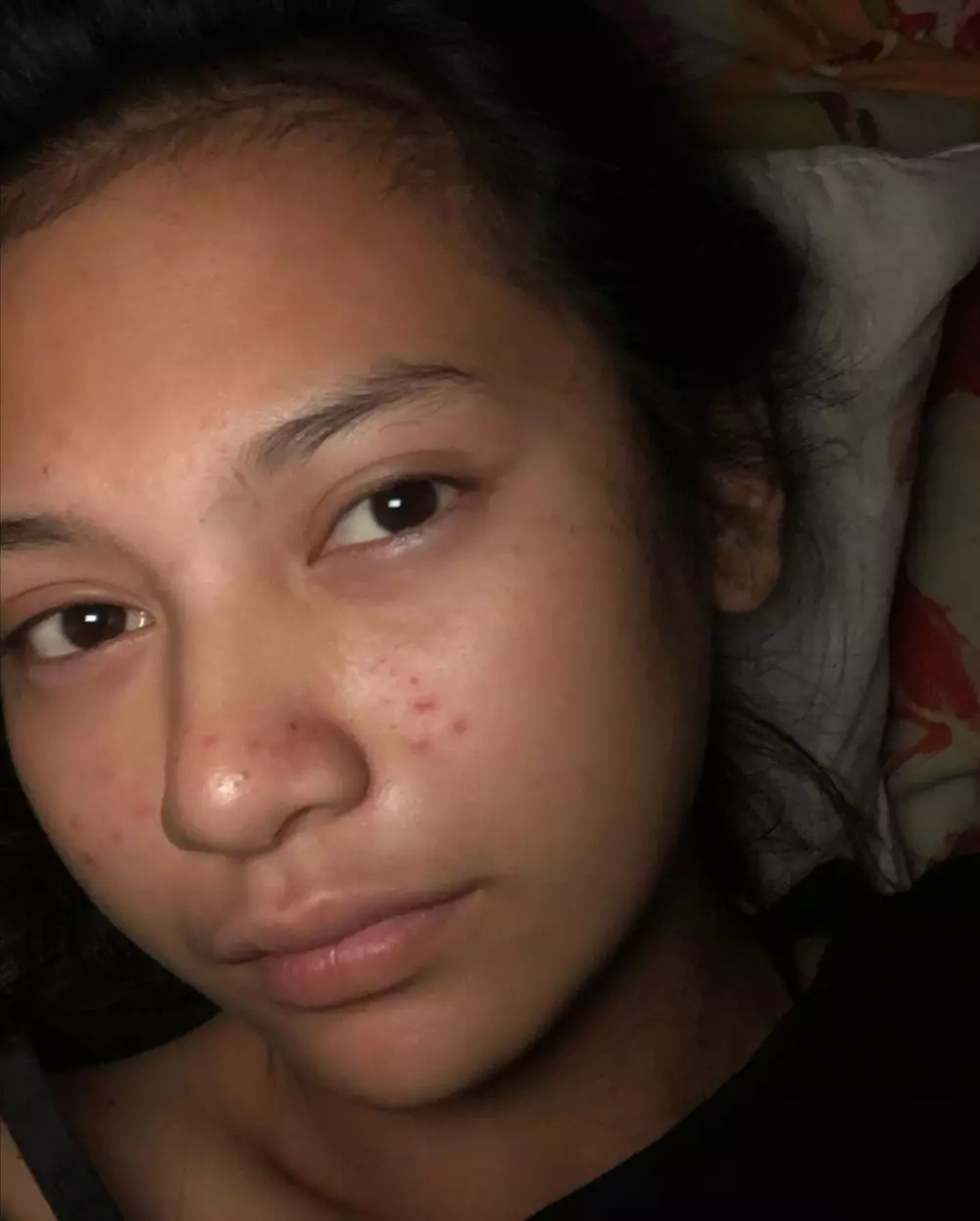 Indah Permatasari jerawatan Instagram