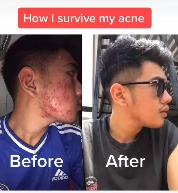 Transformasi lelaki pernah gendut dan jerawatan TikTok/@opaldenhari Transformasi lelaki pernah gendut dan jerawatan TikTok/@opaldenhari