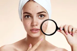 10 Fakta jerawat dan cara mengatasinya, nggak perlu stres dan panik ya