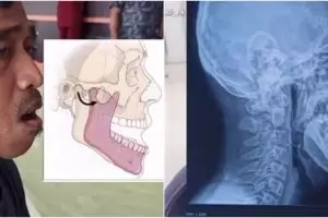 Viral pria alami dislokasi sendi rahang usai menguap terlalu lebar