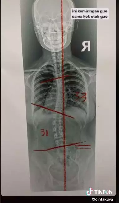 perjuangan cinta kuya hadapi skoliosis © TikTok