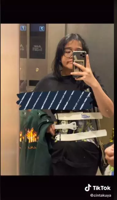 perjuangan cinta kuya hadapi skoliosis © TikTok