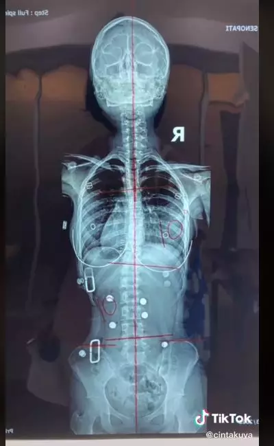 perjuangan cinta kuya hadapi skoliosis © TikTok