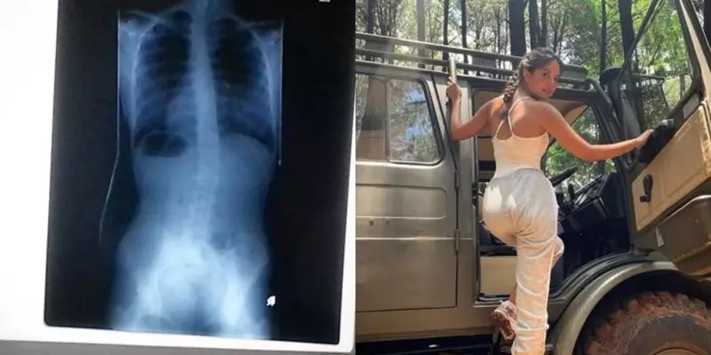 6 Seleb skoliosis © Instagram 6 Seleb skoliosis © Instagram