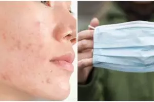 Mengenal maskne, jerawat akibat penggunaan masker selama masa pandemi
