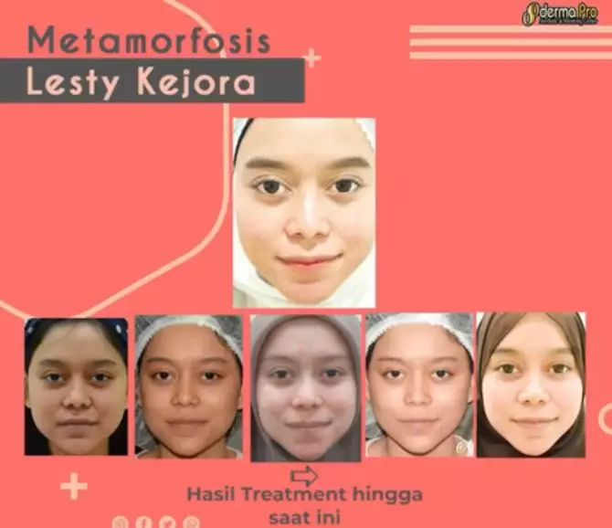 Perawatan kecantikan Lesty Kejora © 2020 brilio.net Instagram Perawatan kecantikan Lesty Kejora © 2020 brilio.net Instagram