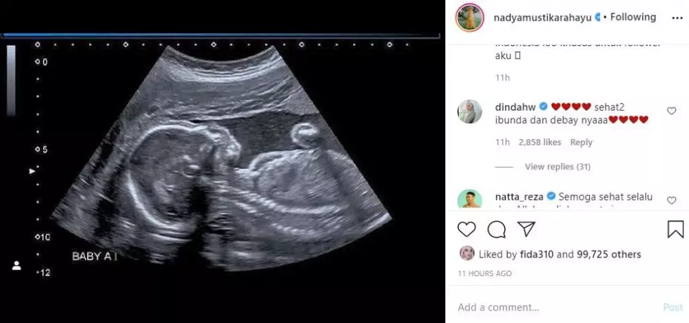 Nadya unggah foto usg © Instagram