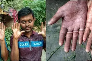 Kisah pria tak miliki sidik jari, sulit bikin SIM dan identitas diri