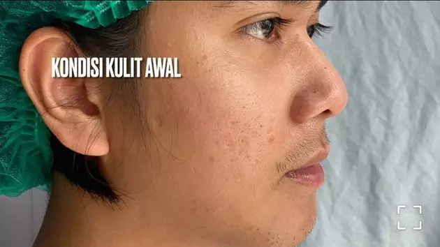 Iqbaal Ramadhan lakukan perawatan kulit © 2021 brilio.net Iqbaal Ramadhan lakukan perawatan kulit © 2021 brilio.net