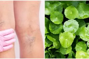 8 Tanaman obat ampuh sembuhkan varises, alami dan mudah ditemukan