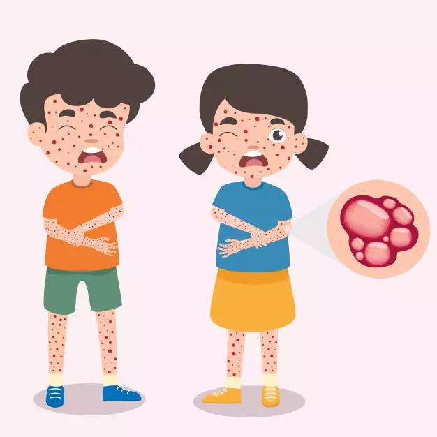 obat hilangkan cacar air © freepik.com