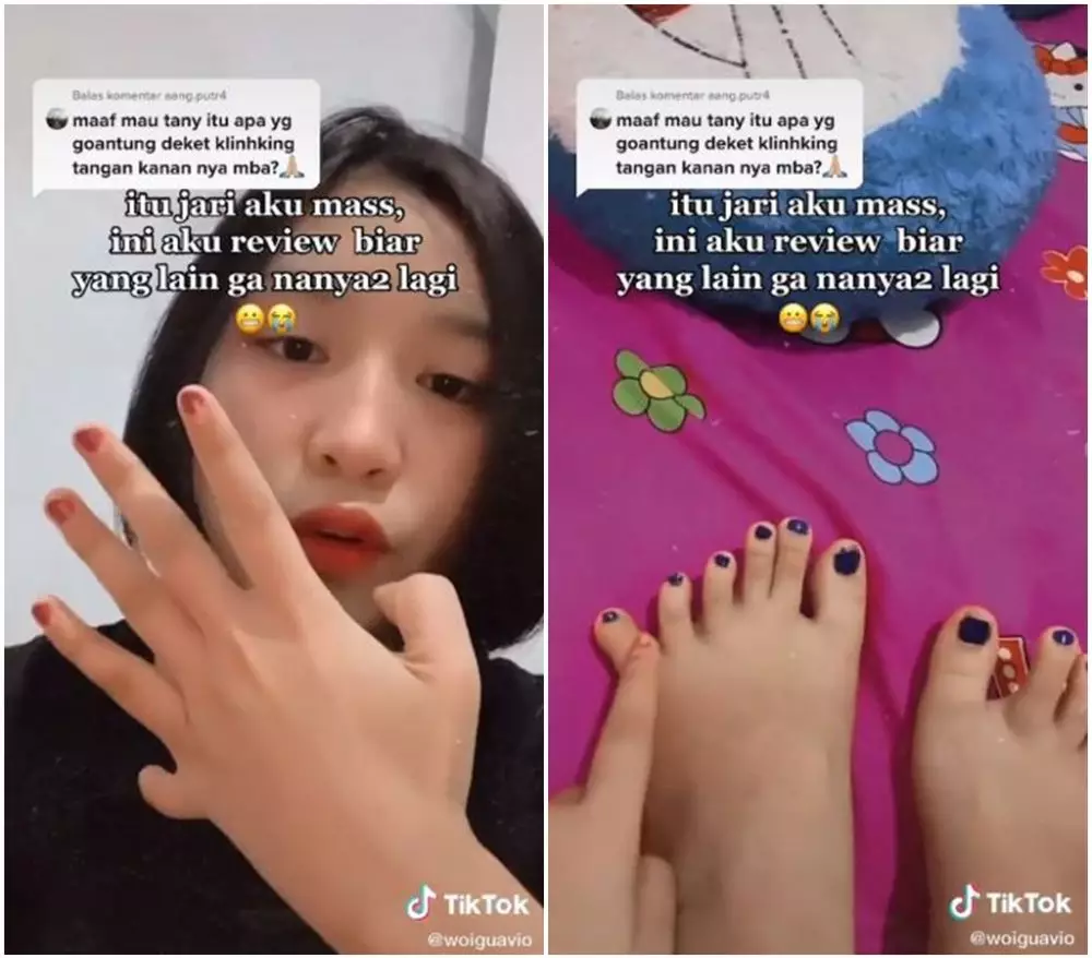 seorang wanita punya 24 jari © 2021 brilio.net seorang wanita punya 24 jari © 2021 brilio.net