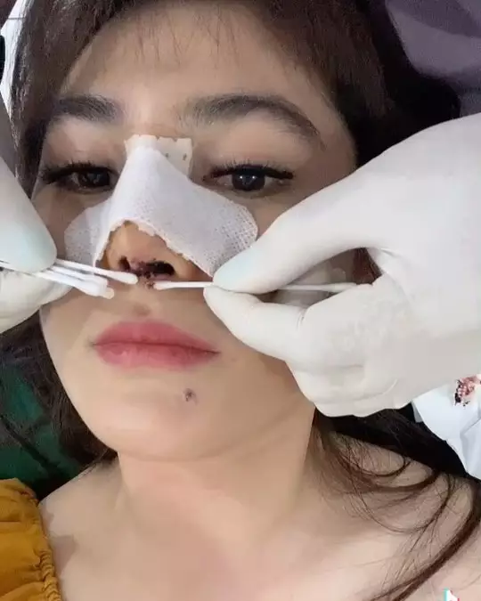Angela Lee usai operasi hidung Instagram