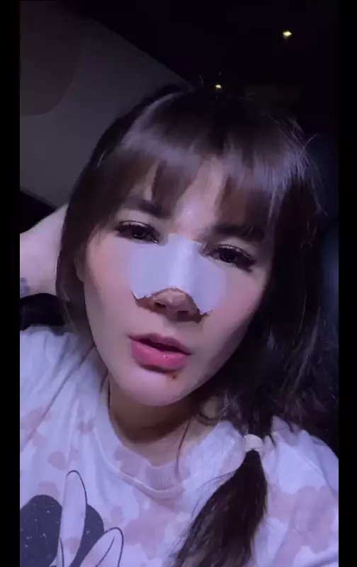Angela Lee usai operasi hidung Instagram