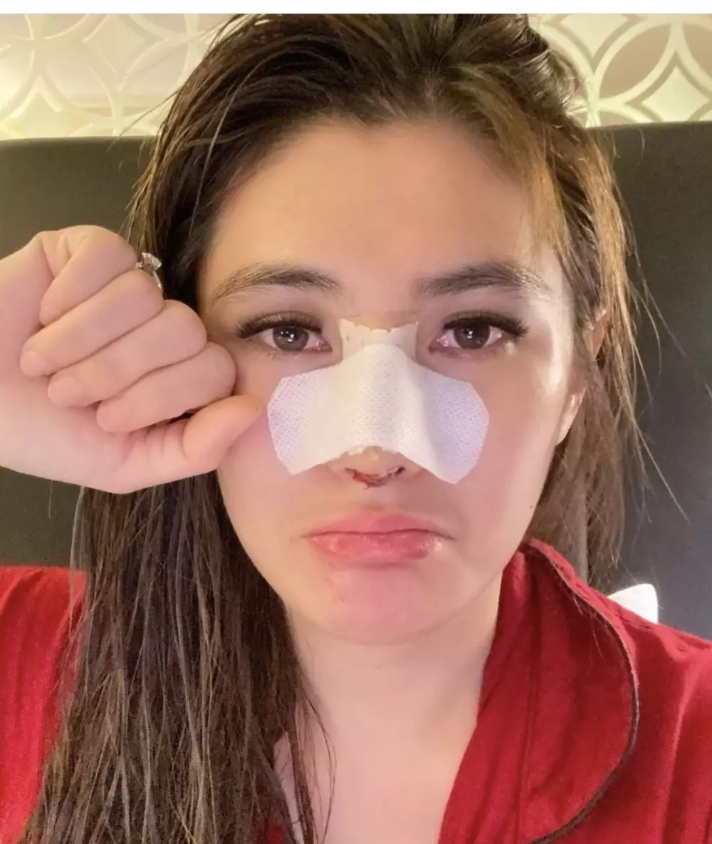 Angela Lee usai operasi hidung Instagram