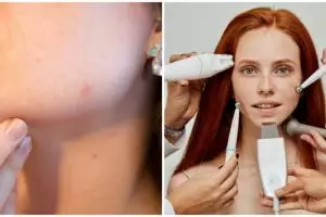 Mengenal hollywood laser, treatment kecantikan mengatasi penuaan dini