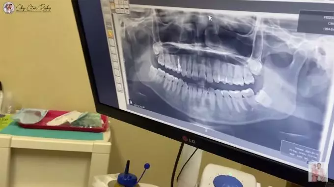 Momen Citra Kirana pasang behel © 2021 brilio.net