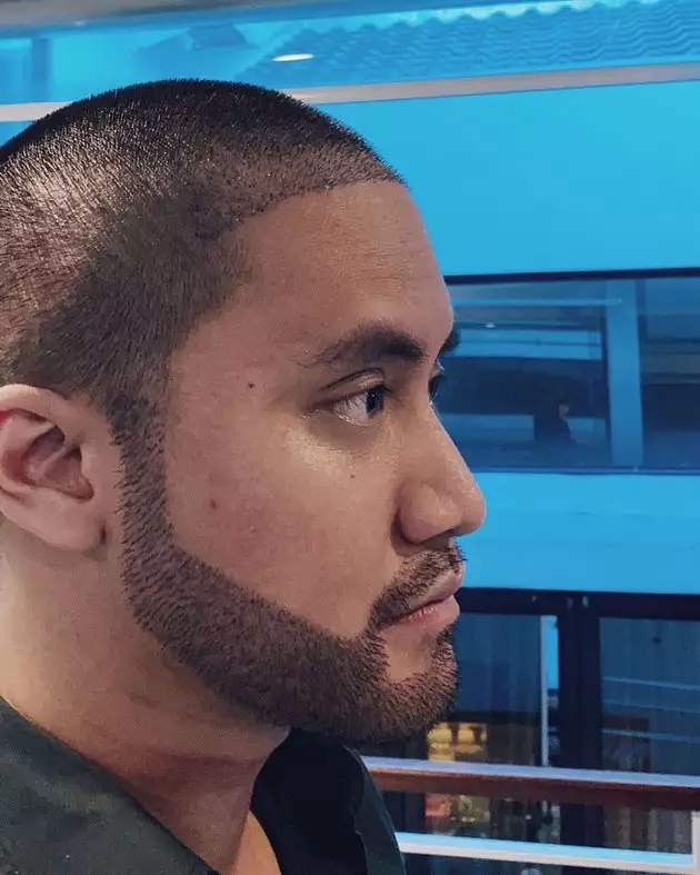 Kevin transplantasi rambut dan brewok Instagram