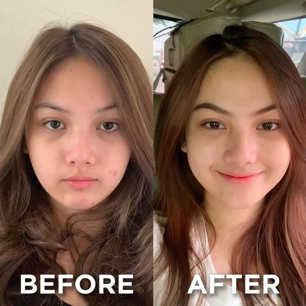 pesinetron tak segan unggah foto berjerawat © berbagai sumber