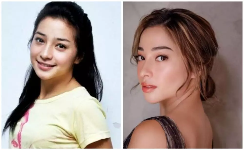 Beda penampilan seleb sebelum dan sesudah filler © berbagai sumber Beda penampilan seleb sebelum dan sesudah filler © berbagai sumber