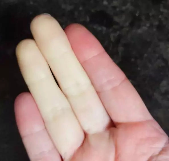 penyakit langka raynaud Instagram