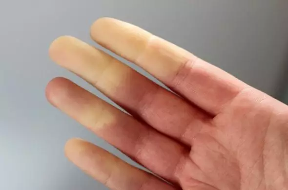 penyakit langka raynaud Instagram