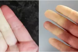 Fenomena sindrom Raynaud, penyakit langka yang belum ada obatnya