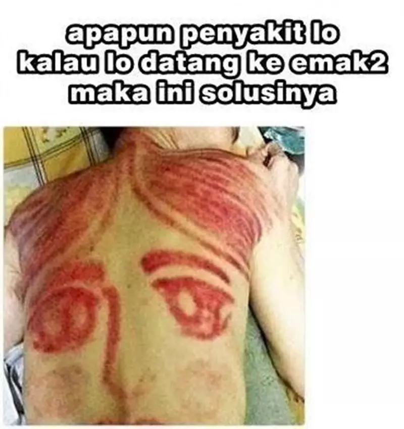 hasil orang kerokan © 2021 berbagai sumber