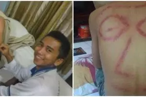 20 Potret orang kerokan hasilnya bikin nyengir kuda