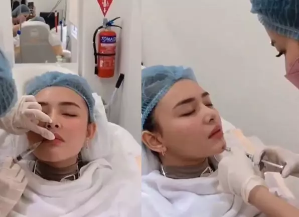 perubahan wajah Amanda Manopo usai suntik wajah © 2021 brilio.net