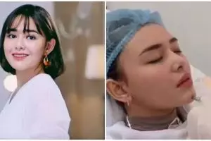 5 Potret perubahan wajah Amanda Manopo usai suntik bibir dan dagu