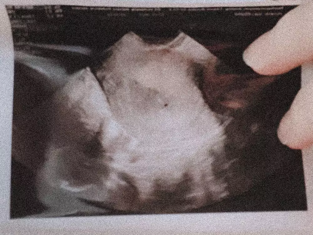 Kondisi terkini Aurel © Istimewa