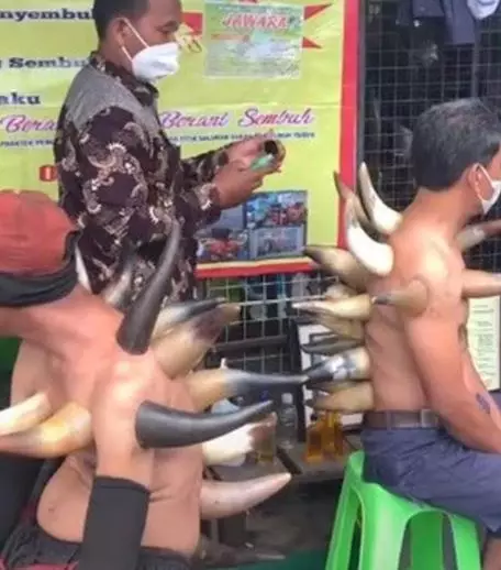 bekam pakai tanduk Berbagai sumber bekam pakai tanduk Berbagai sumber