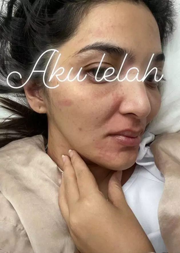 Cerita Ashanty jalani pengobatan autoimun © 2021 brilio.net