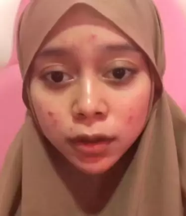 Lesty perlihatkan wajah berjerawat © 2021 brilio.net