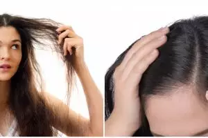 9 Penyebab ketombe beserta cara alami mengatasinya, mudah dan aman