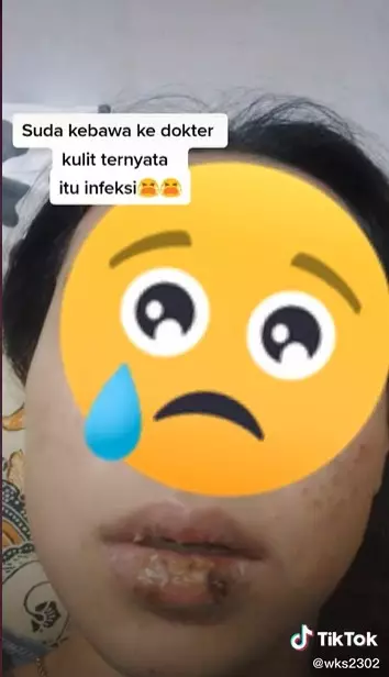 Efek kebiasaan mengelupas bibir © TikTok