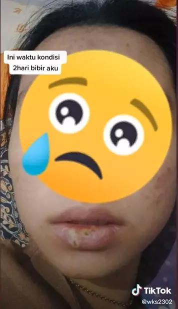 Efek kebiasaan mengelupas bibir © TikTok