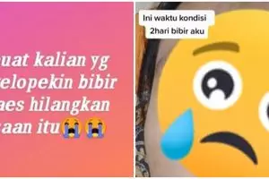 Kebiasaan mengelupas kulit bibir, gadis ini alami kondisi yang serius