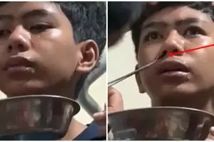Heboh lintah ditemukan di hidung pria ini, warganet auto cek hidung