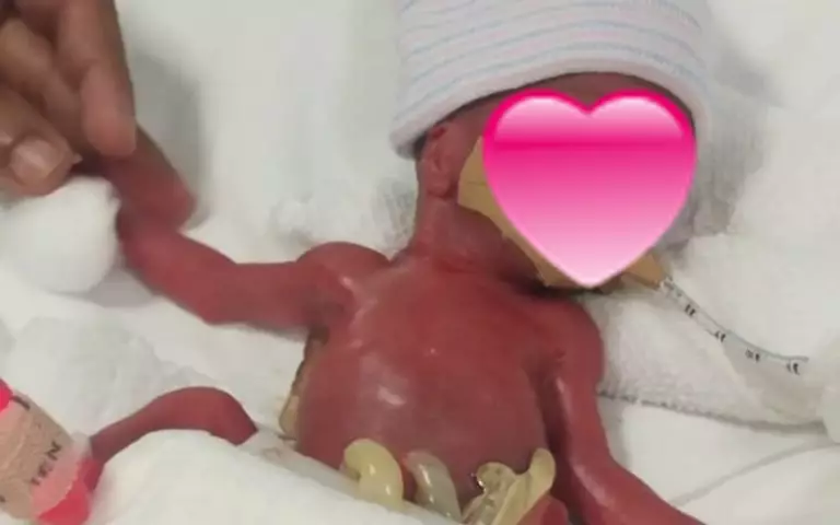 Bayi terkecil di dunia © Istimewa Bayi terkecil di dunia © Istimewa
