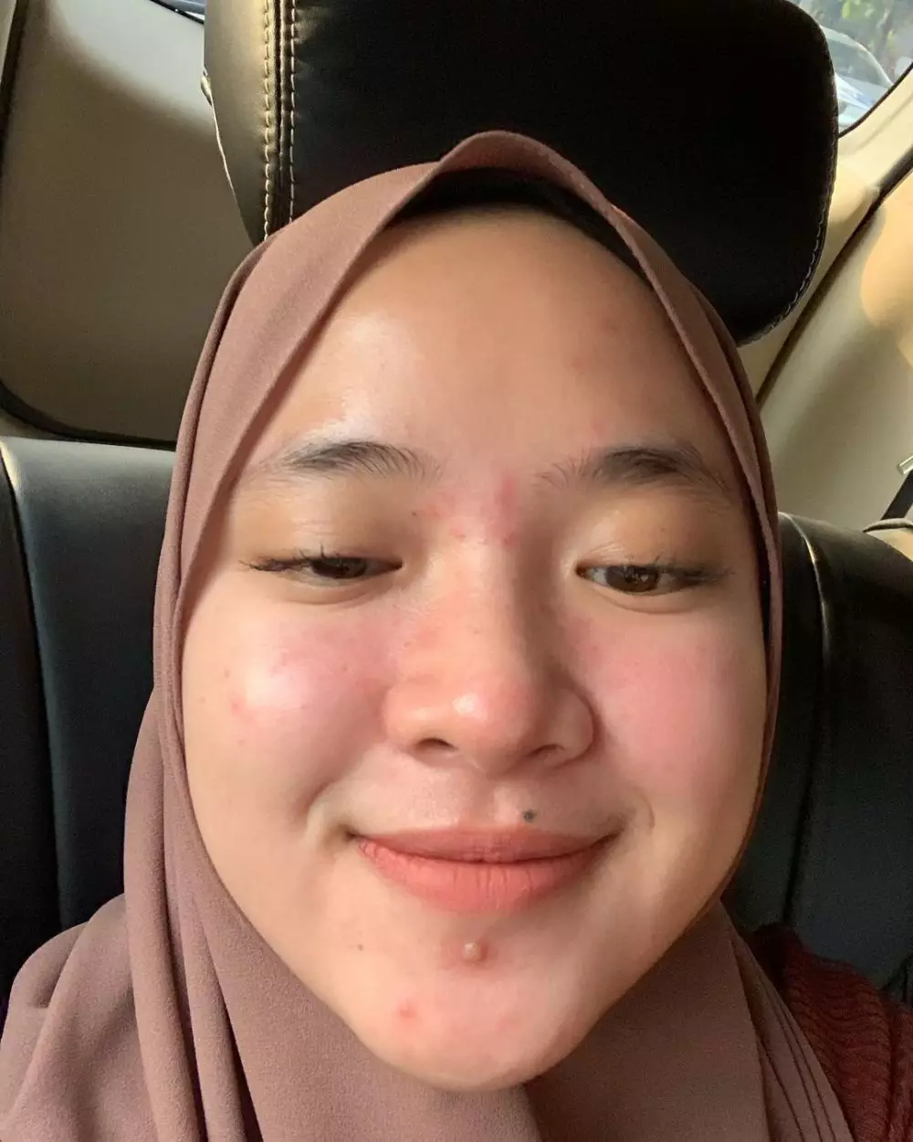 potret nissa sabyan tunjukkan jerawat © instagram potret nissa sabyan tunjukkan jerawat © instagram