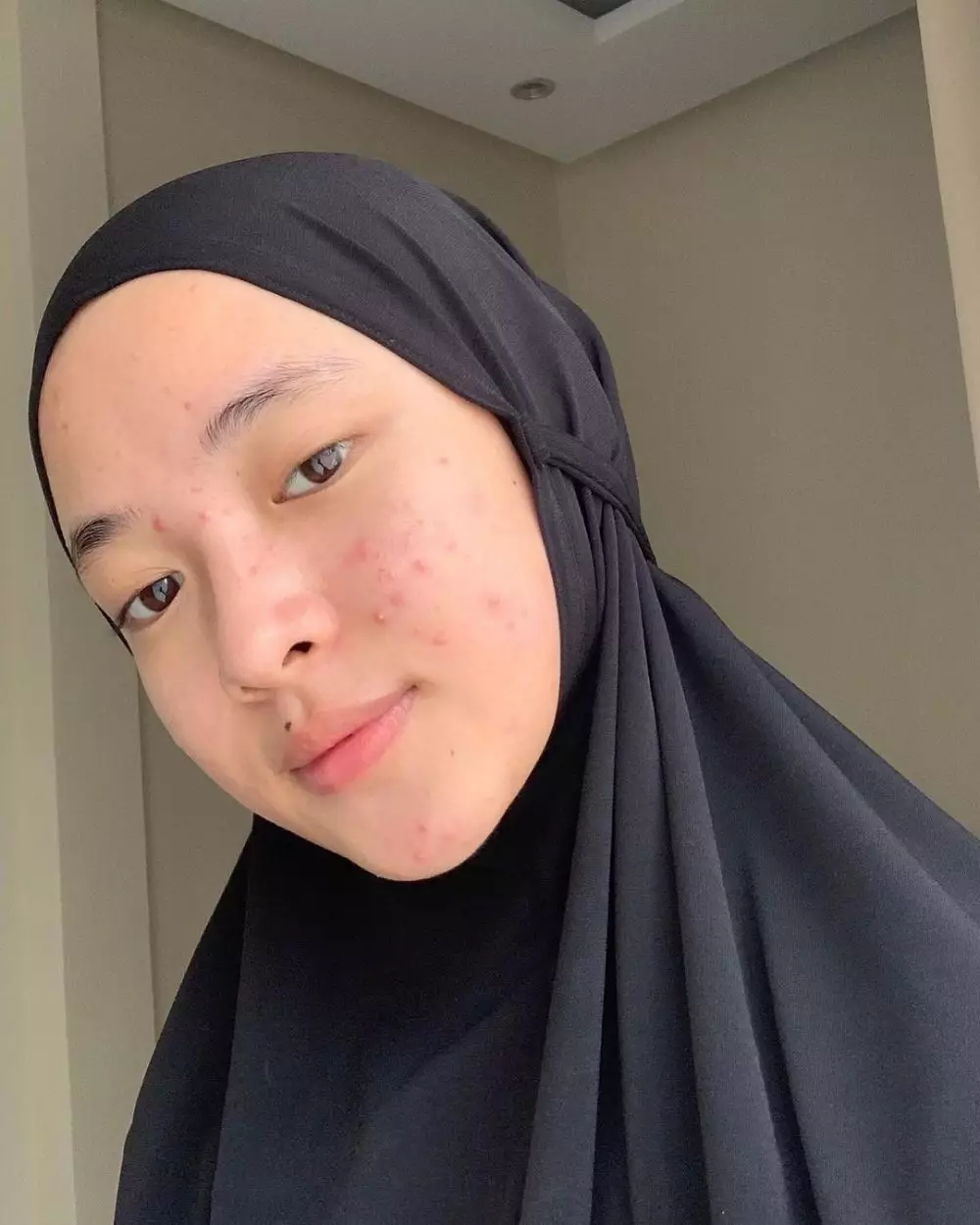 potret nissa sabyan tunjukkan jerawat © instagram potret nissa sabyan tunjukkan jerawat © instagram