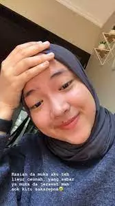 potret nissa sabyan tunjukkan jerawat © instagram potret nissa sabyan tunjukkan jerawat © instagram